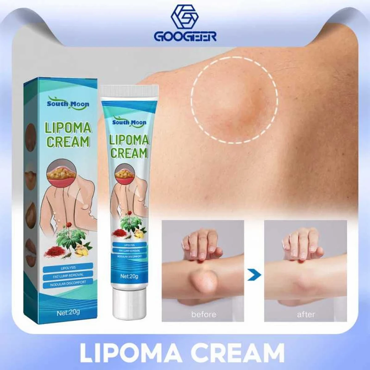 Lipoma Removal Cream-লাইপোমা রিমুভাল ক্রিম